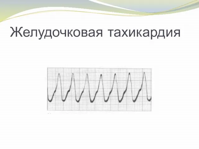 Желудочковая тахикардия