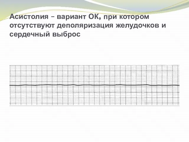 Асистолия – вариант ОК, при котором отсутствуют деполяризация желудочков и сердечный выброс