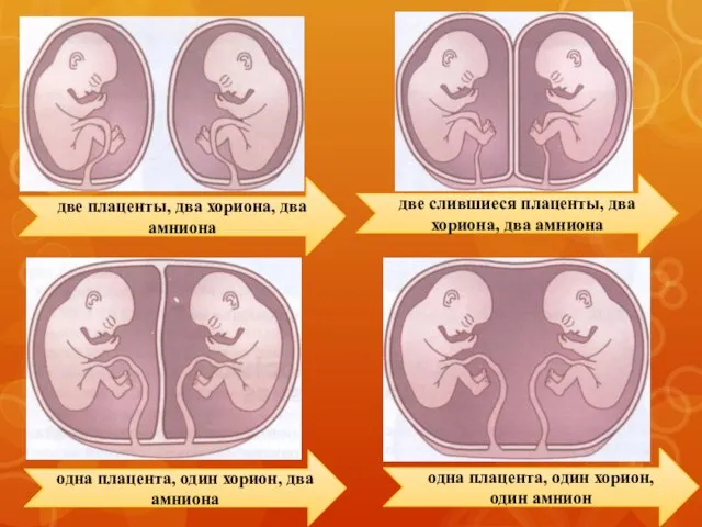 две плаценты, два хориона, два амниона две слившиеся плаценты, два хориона,