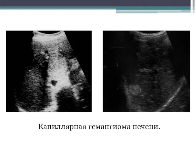 Капиллярная гемангиома печени.