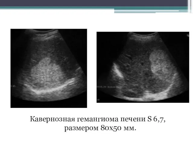 Кавернозная гемангиома печени S 6,7, размером 80х50 мм.