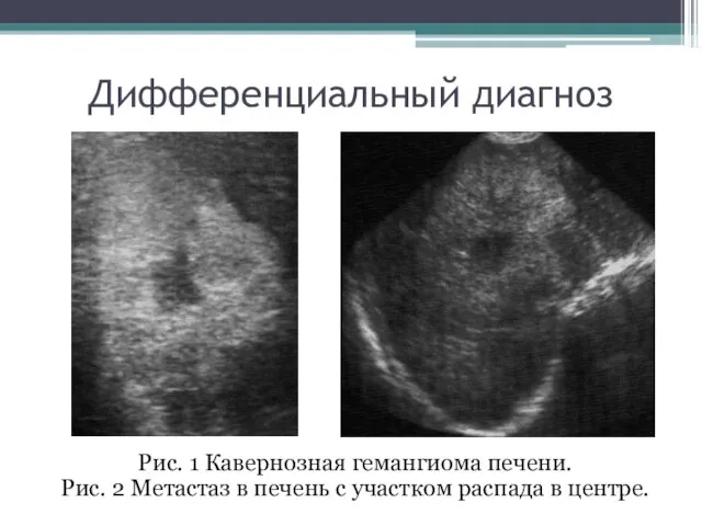 Дифференциальный диагноз Рис. 1 Кавернозная гемангиома печени. Рис. 2 Метастаз в