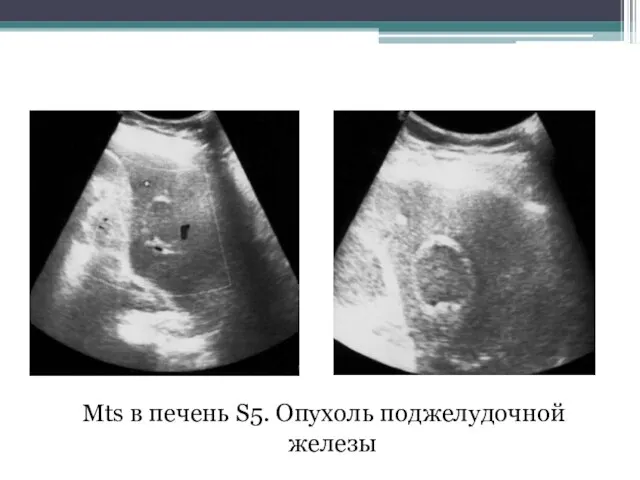 Mts в печень S5. Опухоль поджелудочной железы