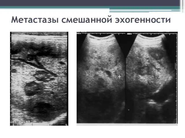 Метастазы смешанной эхогенности