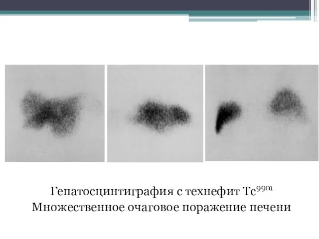 Гепатосцинтиграфия с технефит Tc99m Множественное очаговое поражение печени