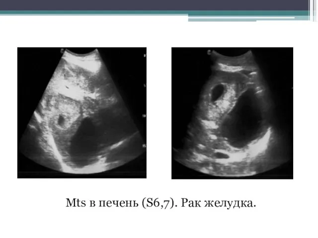 Mts в печень (S6,7). Рак желудка.