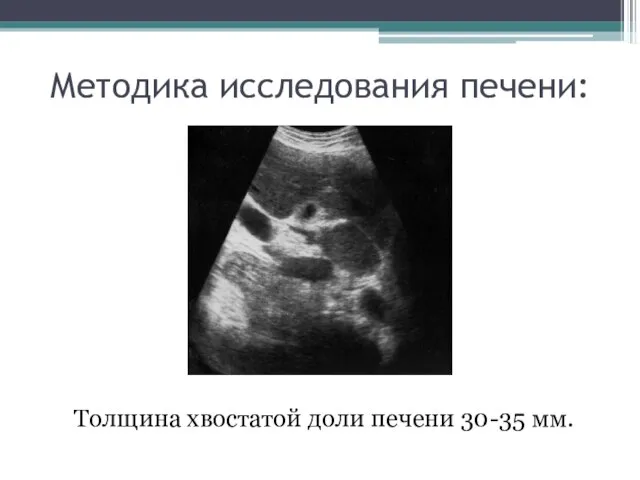 Методика исследования печени: Толщина хвостатой доли печени 30-35 мм.