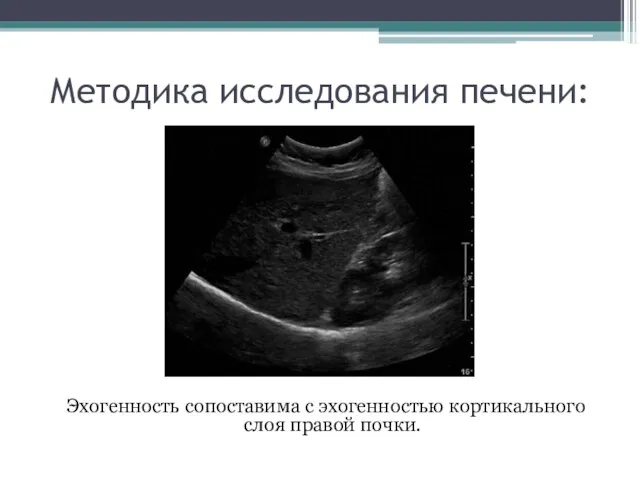 Методика исследования печени: Эхогенность сопоставима с эхогенностью кортикального слоя правой почки.