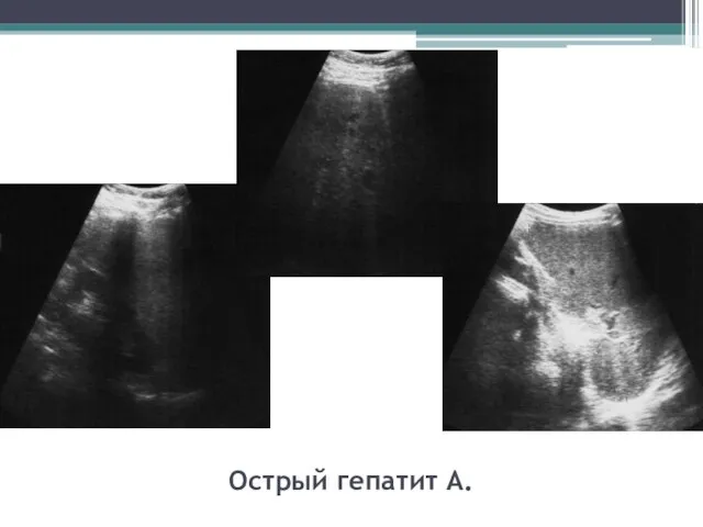 Острый гепатит А.