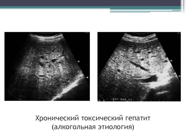 Хронический токсический гепатит (алкогольная этиология)