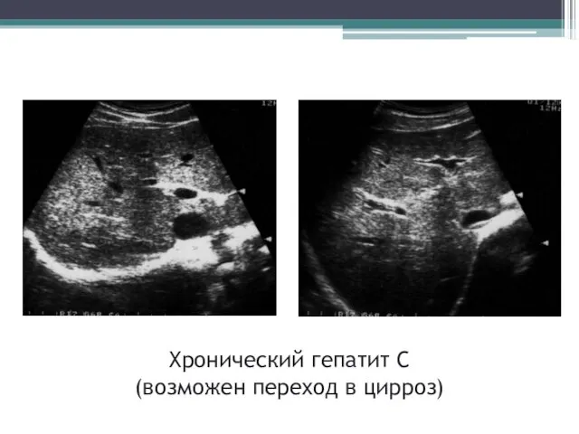 Хронический гепатит С (возможен переход в цирроз)