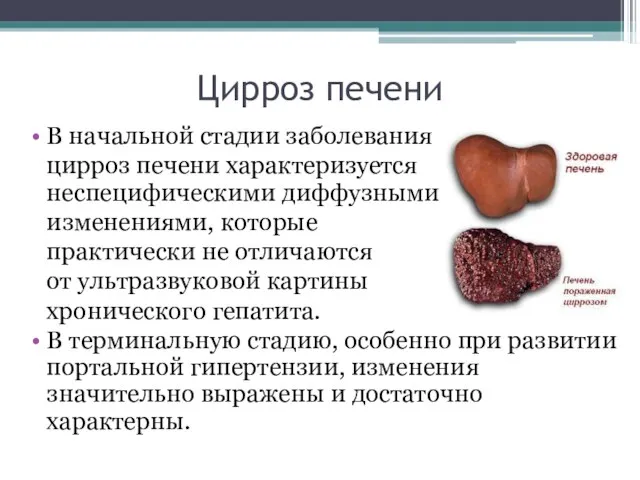 Цирроз печени В начальной стадии заболевания цирроз печени характеризуется неспецифическими диффузными