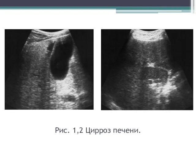 Рис. 1,2 Цирроз печени.