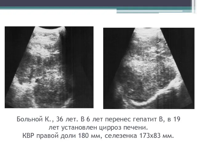 Больной К., 36 лет. В 6 лет перенес гепатит В, в