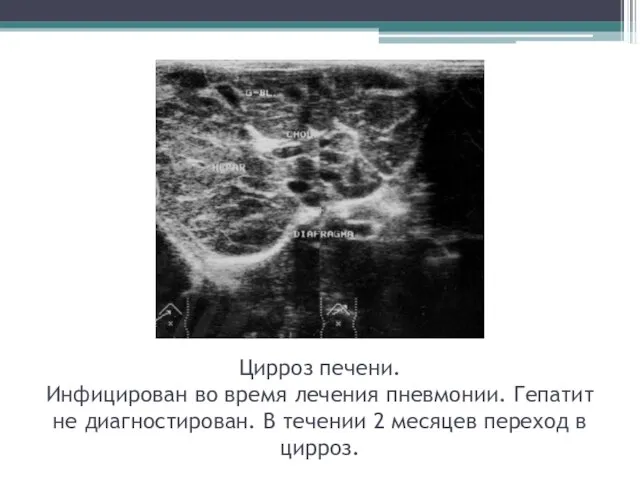 Цирроз печени. Инфицирован во время лечения пневмонии. Гепатит не диагностирован. В