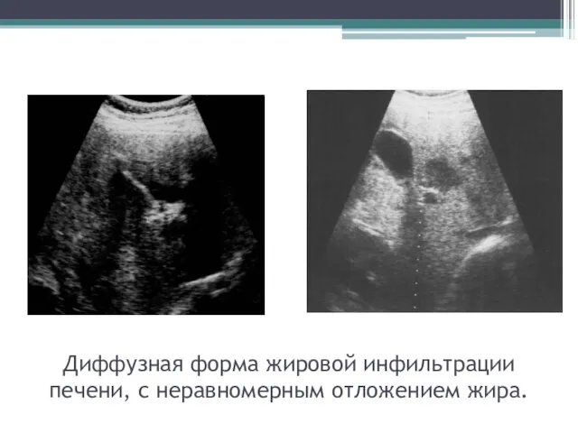 Диффузная форма жировой инфильтрации печени, с неравномерным отложением жира.