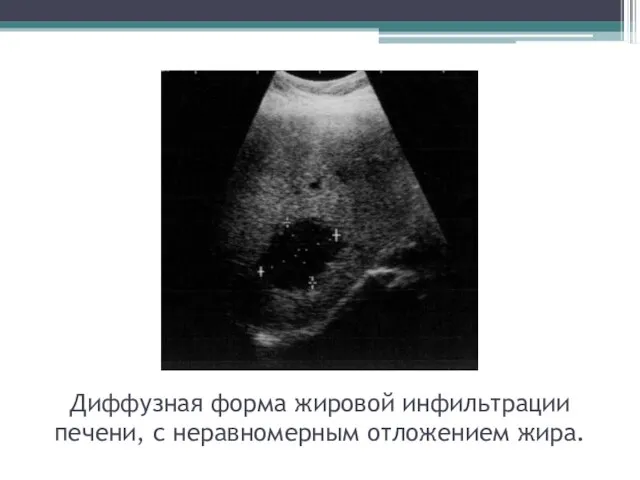 Диффузная форма жировой инфильтрации печени, с неравномерным отложением жира.