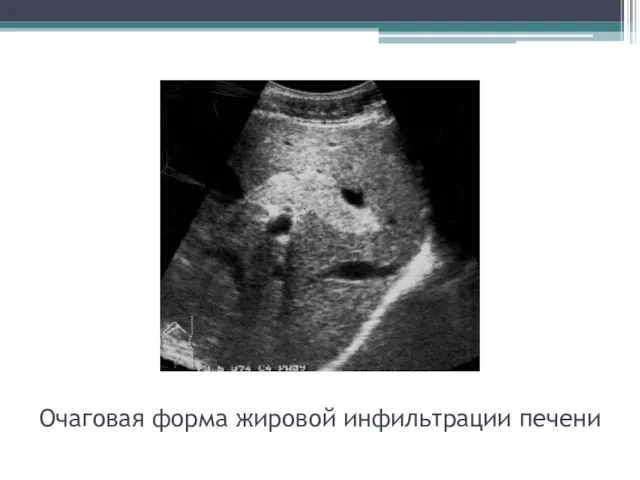 Очаговая форма жировой инфильтрации печени