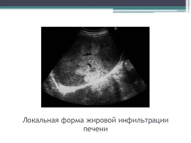 Локальная форма жировой инфильтрации печени