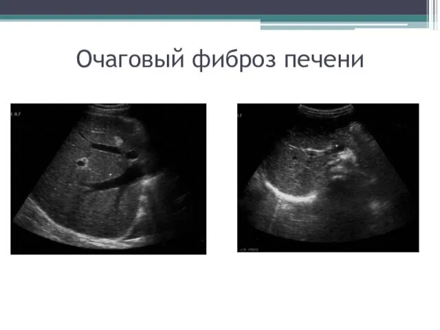 Очаговый фиброз печени