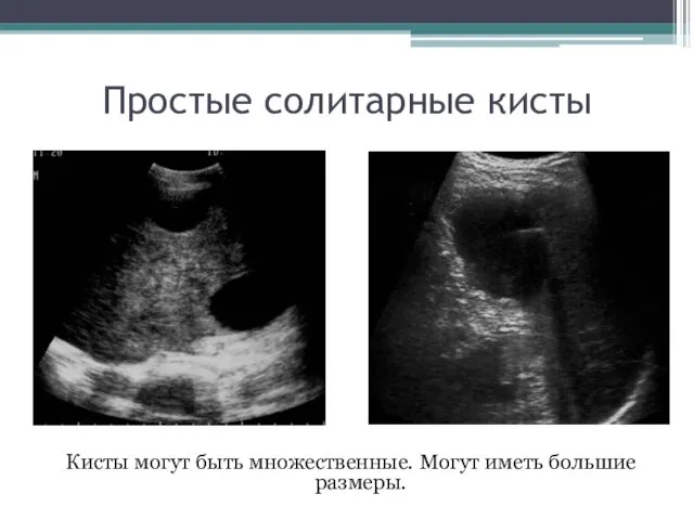 Кисты могут быть множественные. Могут иметь большие размеры. Простые солитарные кисты