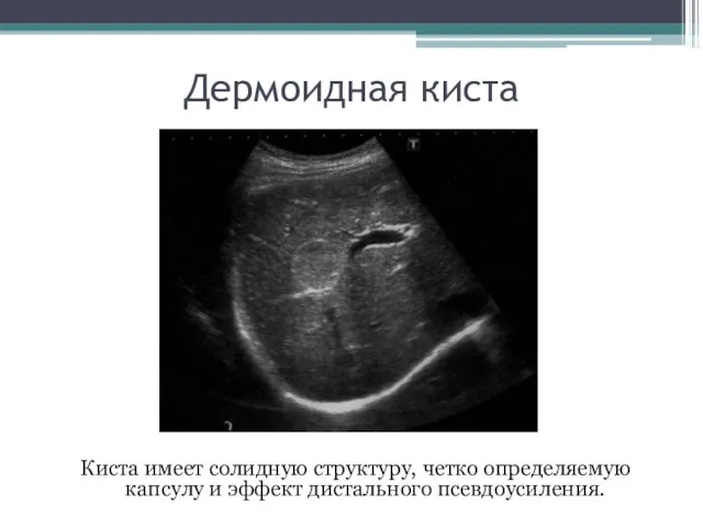 Дермоидная киста Киста имеет солидную структуру, четко определяемую капсулу и эффект дистального псевдоусиления.