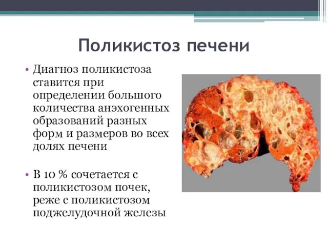 Поликистоз печени Диагноз поликистоза ставится при определении большого количества анэхогенных образований