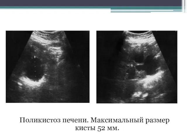 Поликистоз печени. Максимальный размер кисты 52 мм.