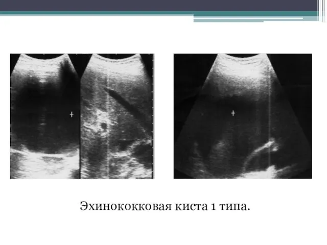 Эхинококковая киста 1 типа.