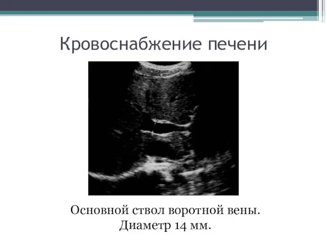 Кровоснабжение печени Основной ствол воротной вены. Диаметр 14 мм.