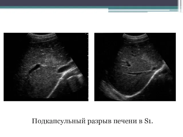 Подкапсульный разрыв печени в S1.