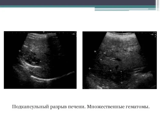 Подкапсульный разрыв печени. Множественные гематомы.