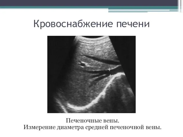 Кровоснабжение печени Печеночные вены. Измерение диаметра средней печеночной вены.