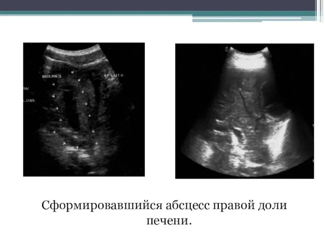 Сформировавшийся абсцесс правой доли печени.