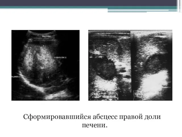 Сформировавшийся абсцесс правой доли печени.