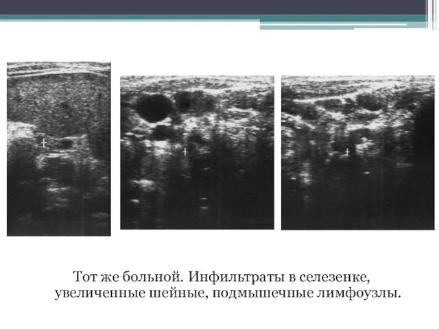 Тот же больной. Инфильтраты в селезенке, увеличенные шейные, подмышечные лимфоузлы.