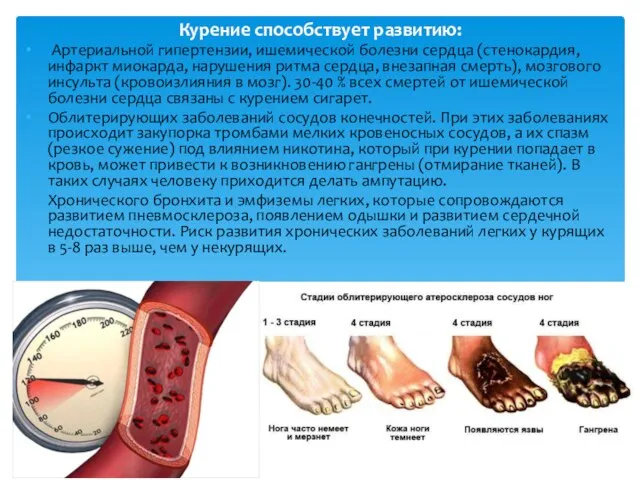 Курение способствует развитию: Артериальной гипертензии, ишемической болезни сердца (стенокардия, инфаркт миокарда,