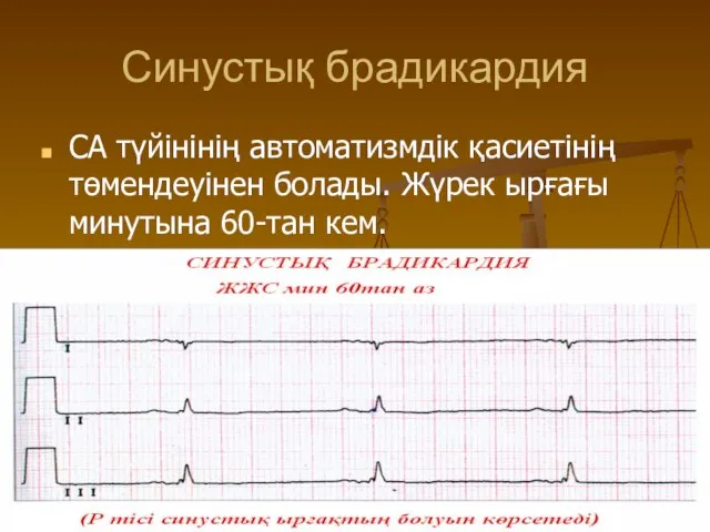 Синустық брадикардия СА түйінінің автоматизмдік қасиетінің төмендеуінен болады. Жүрек ырғағы минутына 60-тан кем.