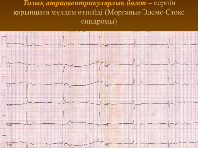 Толық атриовентрикулярлық бөгет – серпін қарыншаға мүлдем өтпейді (Морганьи-Эдемс-Стокс синдромы)