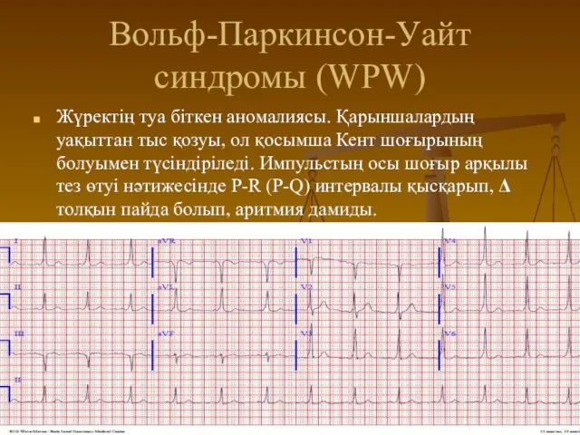 Вольф-Паркинсон-Уайт синдромы (WPW) Жүректің туа біткен аномалиясы. Қарыншалардың уақыттан тыс қозуы,