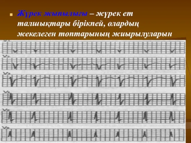 Жүрек жыпылығы – жүрек ет талшықтары бірікпей, олардың жекелеген топтарының жиырылуларын айтады (мин 400-600рет)