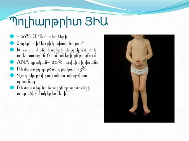 Պոլիարթրիտ ՅԻԱ ~20% ՅԻԱ-ի դեպքերի Հոդերի սիմետրիկ ախտահարում Խոշոր և մանր