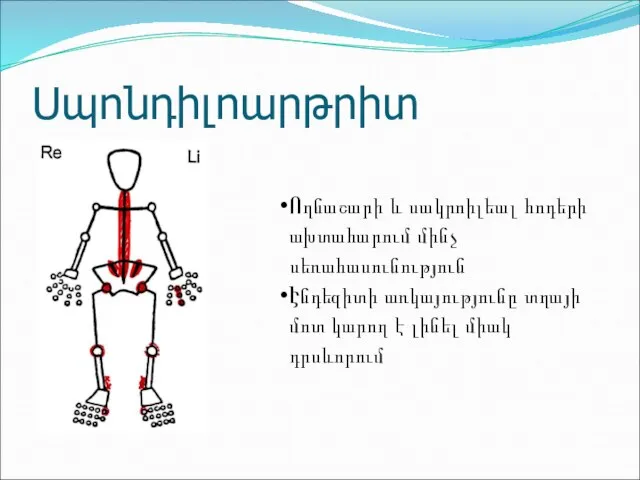 Սպոնդիլոարթրիտ Ողնաշարի և սակրոիլեալ հոդերի ախտահարում մինչ սեռահասունություն Էնդեզիտի առկայությունը տղայի