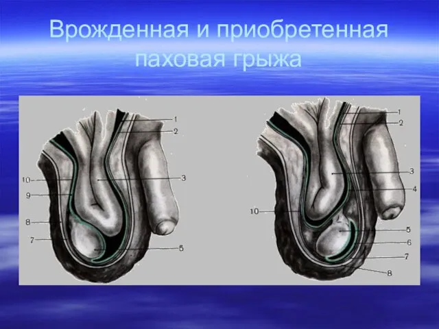 Врожденная и приобретенная паховая грыжа