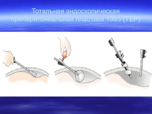 Тотальная эндоскопическая преперитонеальная пластика 1993 (ТЕР)