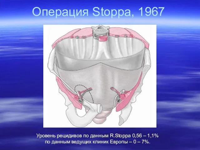 Операция Stoppa, 1967 Уровень рецидивов по данным R.Stoppa 0,56 – 1,1%