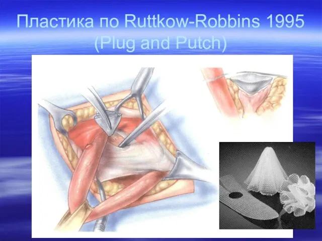 Пластика по Ruttkow-Robbins 1995 (Plug and Putch)