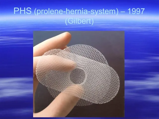 PHS (prolene-hernia-system) – 1997 (Gilbert)