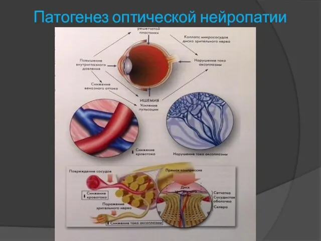 Патогенез оптической нейропатии