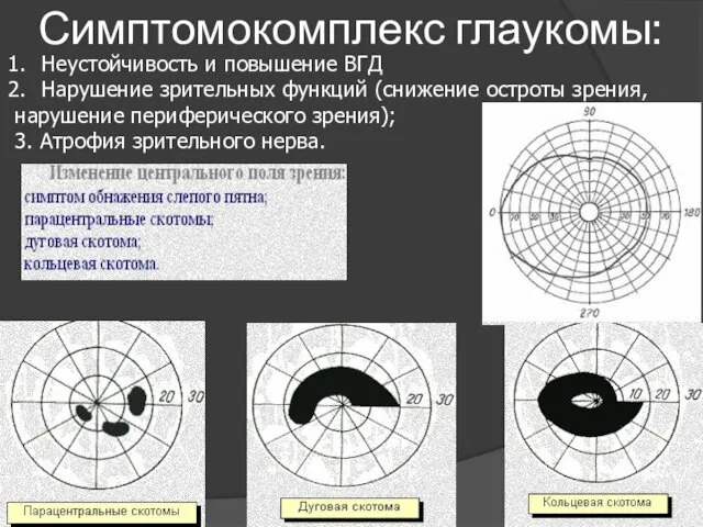 Симптомокомплекс глаукомы: Неустойчивость и повышение ВГД Нарушение зрительных функций (снижение остроты